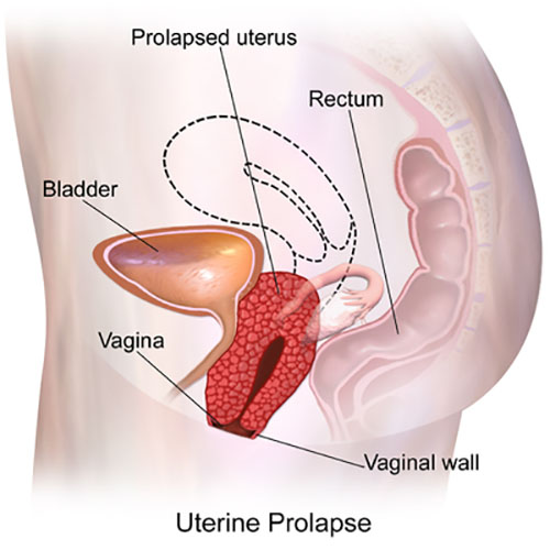 Treatment of Prolapse Uterus